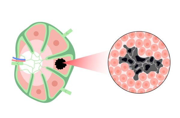 Illustration of tumor response and cancer cell reduction