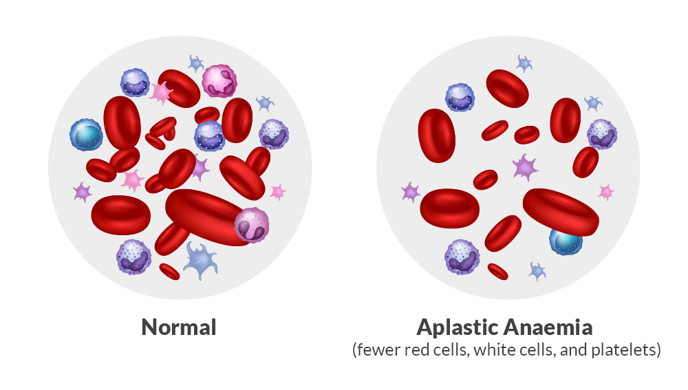 Normal vs Aplastic Anemia