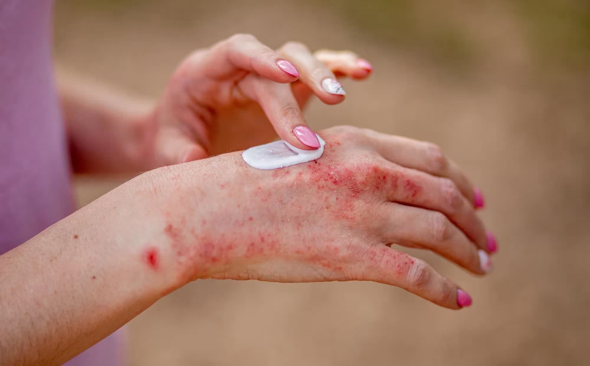 Close-up of a hand with atopic dermatitis flare-up applying cream