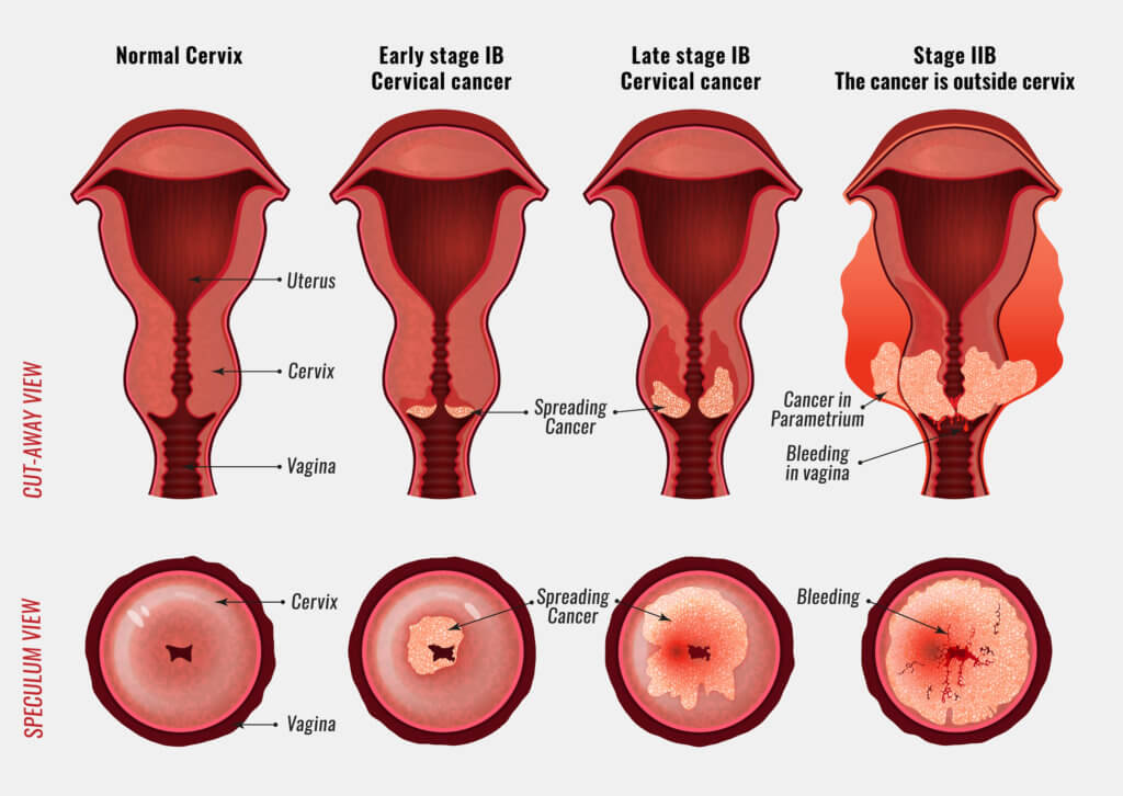 Cervical Cancer Screening