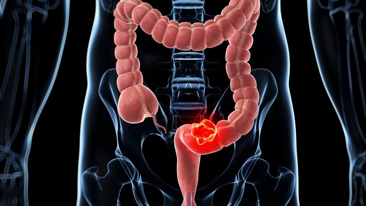 Colorectal Cancer Immunotherapy: How MSI-H/dMMR Helps Identify Patients Who May Benefit