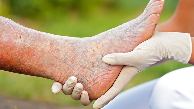 Critical Limb Ischemia