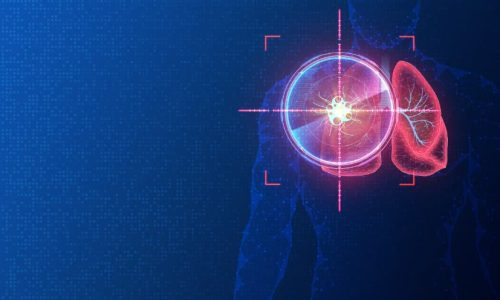 Cryoablation Therapy
