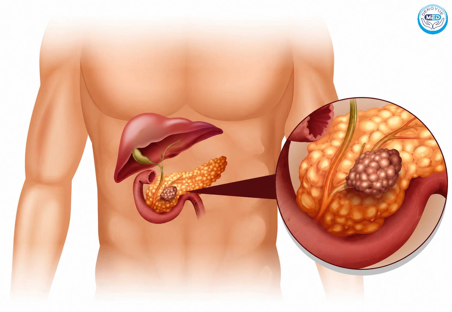 What Has Daraxonrasib Improved Over Traditional Treatments in Third-Line Pancreatic Cancer?
