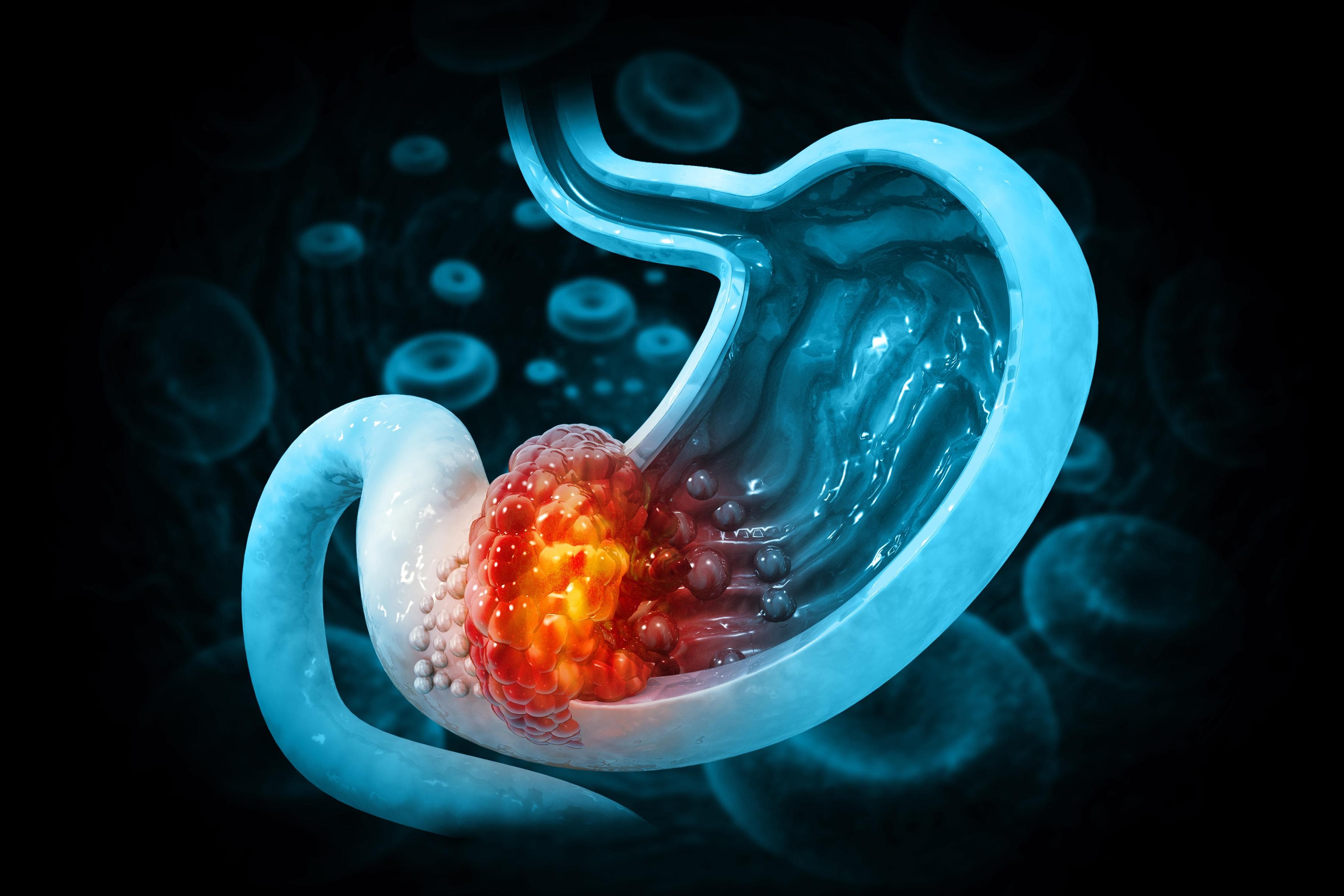 Gastric Cancer Treatment Is No Longer Just About Chemotherapy: How Precision Medicine Is Shaping the Future | A Comprehensive Guide to HER2, CLDN18.2, and FGFR2b