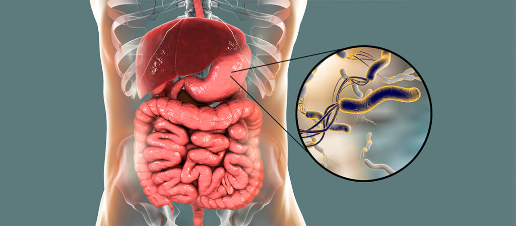 Is Helicobacter pylori Infection Guaranteed to Cause Stomach Cancer? Many People Have Misunderstood It