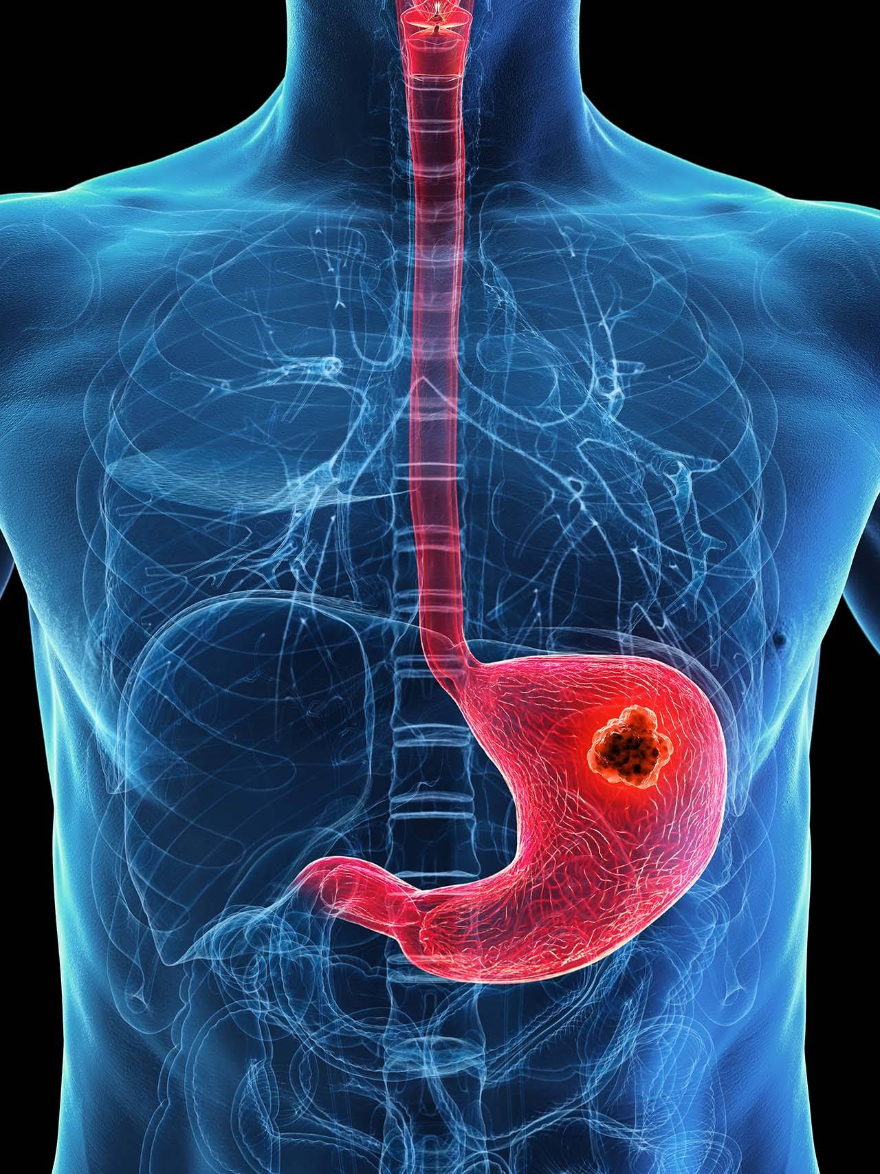Helicobacter pylori and stomach cancer