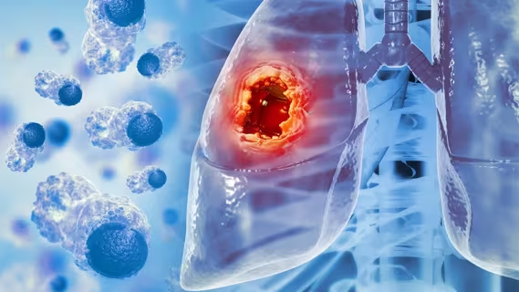 Advances in the Treatment of HER2-Mutant Advanced Non-Small Cell Lung Cancer