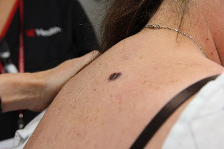 Pigmented skin lesion consistent with melanoma