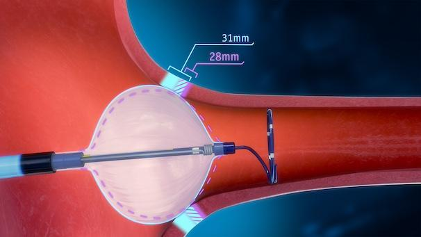 NanoKnife Therapy