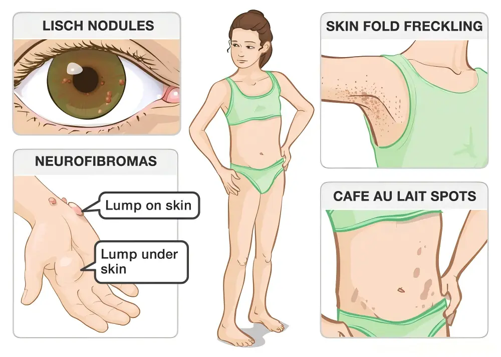 NF1-Associated Plexiform Neurofibroma: Treatment Needs and the Latest Advances in Adult Patients