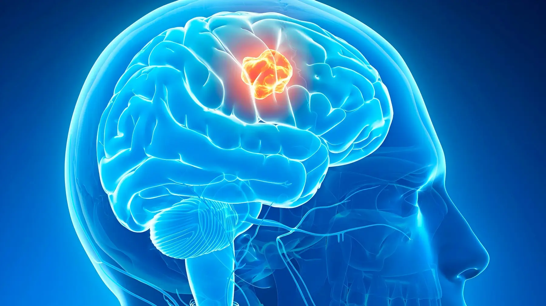 What Targeted Drugs Are Available for NTRK Fusion Brain Tumors? An Overview of Larotrectinib and Entrectinib Applications