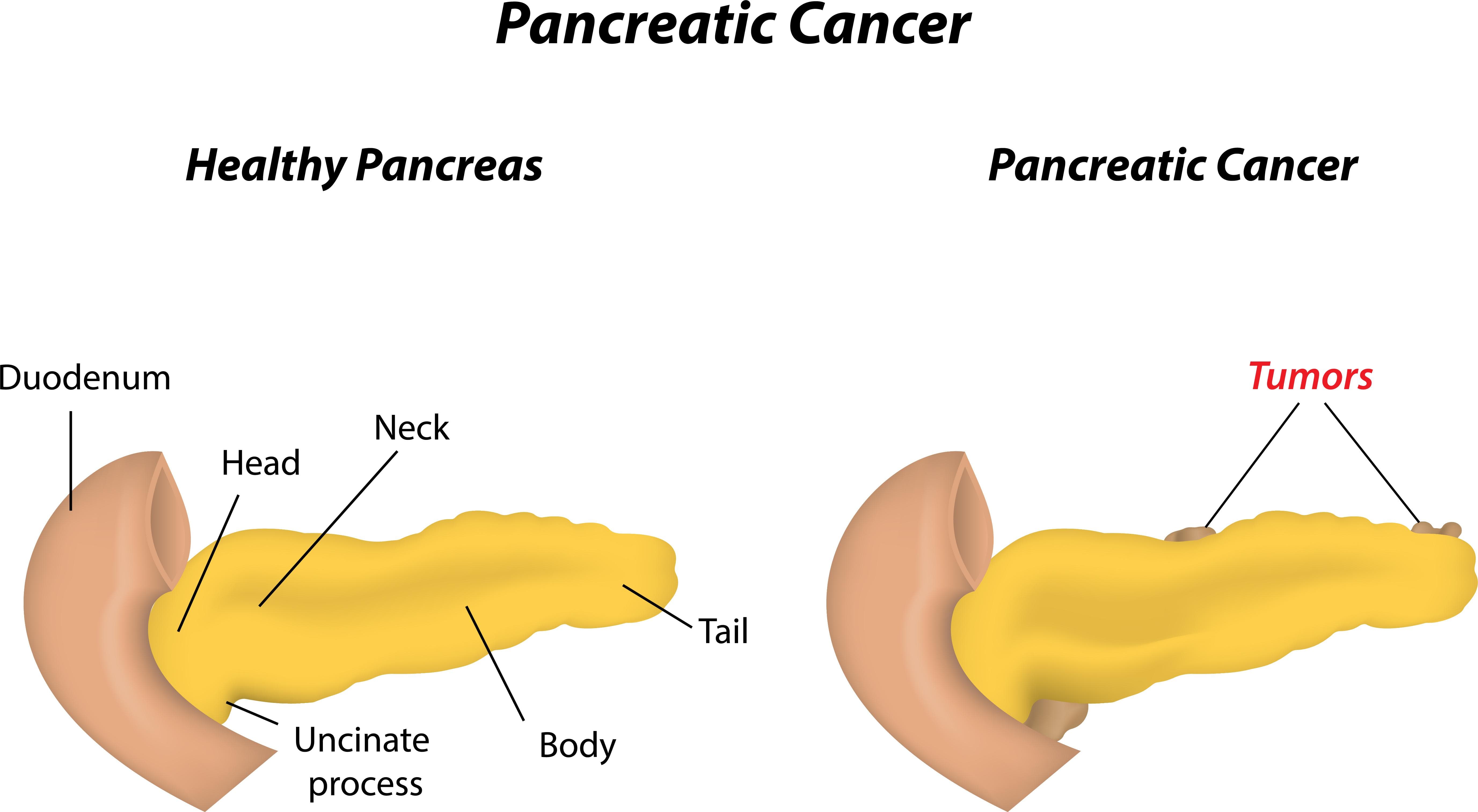 Where Pancreatic Cancer Develops Matters: Understanding Pancreatic Head Cancer vs. Body and Tail Cancer
