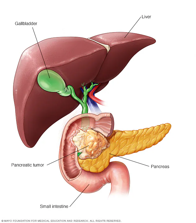 Pancreatic Tumor Illustration