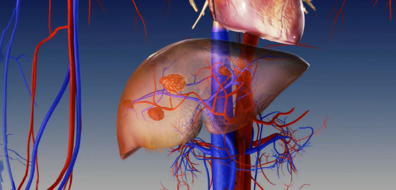 Y-90 (Yttrium-90) Treatment in China: A New Interventional Radiotherapy Option for International Liver Cancer Patients